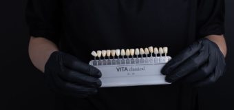 Знакомьтесь, виниры: назначение, преимущества и недостатки